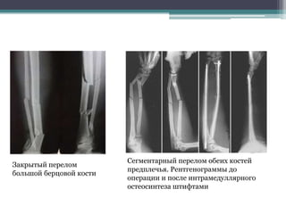 Закрытый перелом 
большой берцовой кости 
Сегментарный перелом обеих костей 
предплечья. Рентгенограммы до 
операции и после интрамедуллярного 
остеосинтеза штифтами 
 