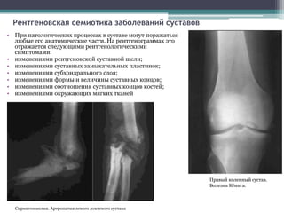 Рентгеновская семиотика заболеваний суставов 
• При патологических процессах в суставе могут поражаться 
любые его анатомические части. На рентгенограммах это 
отражается следующими рентгенологическими 
симптомами: 
• изменениями рентгеновской суставной щели; 
• изменениями суставных замыкательных пластинок; 
• изменениями субхондрального слоя; 
• изменениями формы и величины суставных концов; 
• изменениями соотношения суставных концов костей; 
• изменениями окружающих мягких тканей 
Правый коленный сустав. 
Болезнь Кёнига. 
Сирингомиелия. Артропатия левого локтевого сустава 
 