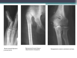 Вывих средней фаланги 
5 пальца кисти 
Врожденный вывих бедра с 
образованием неоартроза 
Хондроматоз левого локтевого сустава. 
 