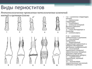 Виды периоститов 
Рентгенологические проявления патологических изменений 
костей и суставов (схема 
• 1-5 — изменение структуры 
костей: 
1 — нормальная 
структура; 
2 — остеопороз; 
3 — остеолиз концевой 
фаланги (указано 
стрелкой); 
4 — очаги деструкции и 
секвестр; 
5 — остеосклероз; 
6-10 — изменения 
надкостницы и суставов: 
6 — отслоенный 
периостит; 
7 — бахромчатый 
(кружевной) периостит и 
артрит (деструкция 
суставных поверхностей) 
8 — игольчатый 
периостит (спикулы), 
периостальные козырьки 
(указано стрелкой); 
деформирующий артроз; 
9 — «луковичный» 
периостит, костный 
анкилоз; 
10 — ассимиляция 
периостальных наслоений; 
подвывих в суставе. 
