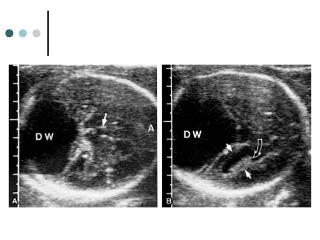 Dandy Walker Syndrome