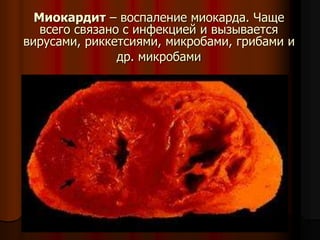 Миокардит – воспаление миокарда. Чаще
всего связано с инфекцией и вызывается
вирусами, риккетсиями, микробами, грибами и
др. микробами
 