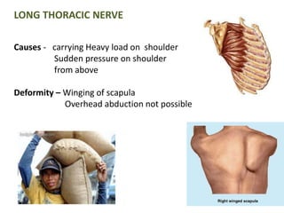 LONG THORACIC NERVE 
Causes - carrying Heavy load on shoulder 
Sudden pressure on shoulder 
from above 
Deformity – Winging of scapula 
Overhead abduction not possible 
 