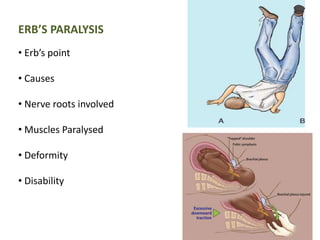ERB’S PARALYSIS 
• Erb’s point 
• Causes 
• Nerve roots involved 
• Muscles Paralysed 
• Deformity 
• Disability 
 