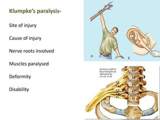 Klumpke’s paralysis- 
Site of injury 
Cause of injury 
Nerve roots involved 
Muscles paralysed 
Deformity 
Disability 
 