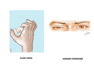 CLAW HAND HORNER SYNDROME 
 