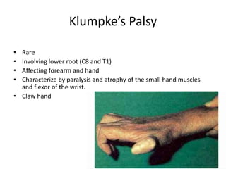 Klumpke’s Palsy 
• Rare 
• Involving lower root (C8 and T1) 
• Affecting forearm and hand 
• Characterize by paralysis and atrophy of the small hand muscles 
and flexor of the wrist. 
• Claw hand 
 
