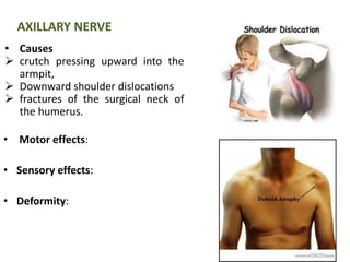 AXILLARY NERVE 
• Causes 
 crutch pressing upward into the 
armpit, 
 Downward shoulder dislocations 
 fractures of the surgical neck of 
the humerus. 
• Motor effects: 
• Sensory effects: 
• Deformity: 
 