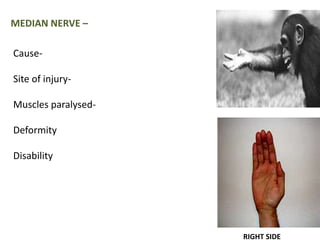 MEDIAN NERVE – 
Cause- 
Site of injury- 
Muscles paralysed- 
Deformity 
Disability 
RIGHT SIDE 
 