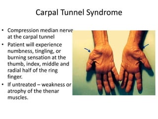Carpal Tunnel Syndrome 
• Compression median nerve 
at the carpal tunnel 
• Patient will experience 
numbness, tingling, or 
burning sensation at the 
thumb, index, middle and 
radial half of the ring 
finger. 
• If untreated – weakness or 
atrophy of the thenar 
muscles. 
 