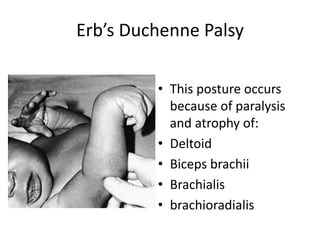 Erb’s Duchenne Palsy 
• This posture occurs 
because of paralysis 
and atrophy of: 
• Deltoid 
• Biceps brachii 
• Brachialis 
• brachioradialis 
 