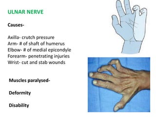 ULNAR NERVE 
Causes- 
Axilla- crutch pressure 
Arm- # of shaft of humerus 
Elbow- # of medial epicondyle 
Forearm- penetrating injuries 
Wrist- cut and stab wounds 
Muscles paralysed- 
Deformity 
Disability 
 