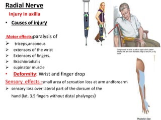 Radial Nerve 
Injury in axilla 
• Causes of injury 
Motor effects:paralysis of 
 triceps,anconeus 
 extensors of the wrist 
 Extensors of fingers. 
 Brachioradialis 
 supinator muscle 
• Deformity: Wrist and finger drop 
Sensory effects -small area of sensation loss at arm andforearm 
 sensory loss over lateral part of the dorsum of the 
hand (lat. 3.5 fingers without distal phalynges) 
 