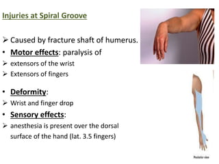 Injuries at Spiral Groove 
 Caused by fracture shaft of humerus. 
• Motor effects: paralysis of 
 extensors of the wrist 
 Extensors of fingers 
• Deformity: 
 Wrist and finger drop 
• Sensory effects: 
 anesthesia is present over the dorsal 
surface of the hand (lat. 3.5 fingers) 
 
