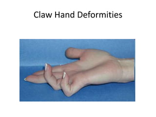 Claw Hand Deformities 
 