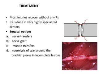 TREATMENT 
• Most injuries recover without any Rx 
• Rx is done in very highly specialized 
centers 
• Surgical options 
a. nerve transfers 
b. nerve graft 
c. muscle transfers 
d. neurolysis of scar around the 
brachial plexus in incomplete lesions. 
 