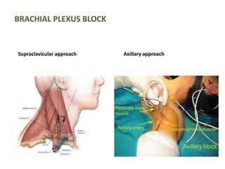 BRACHIAL PLEXUS BLOCK 
Supraclavicular approach Axillary approach 
 