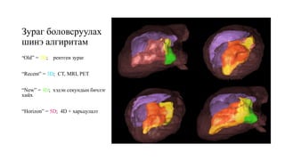 Зураг боловсруулах
шинэ алгиритам
“Old” = 2D; рентген зураг
“Recent” = 3D; CT, MRI, PET
“New” = 4D; хэдэн секундын бичлэг
хийх
“Horizon” = 5D; 4D + харьцулалт
Color depicts chamber contraction sequence during heart beat
 