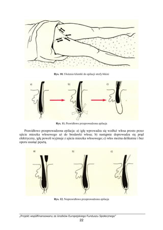 „Projekt współfinansowany ze środków Europejskiego Funduszu Społecznego”
22
Rys. 10. Ułożenie klientki do epilacji strefy bikini
Rys. 11. Prawidłowo przeprowadzona epilacja
Prawidłowo przeprowadzona epilacja: a) igłę wprowadza się wzdłuż włosa prosto przez
ujście mieszka włosowego aż do brodawki włosa; b) następnie doprowadza się prąd
elektryczny, igłę powoli wyjmuje z ujścia mieszka włosowego; c) włos można delikatnie i bez
oporu usunąć pęsetą.
Rys. 12. Nieprawidłowo przeprowadzona epilacja
 