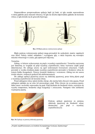 „Projekt współfinansowany ze środków Europejskiego Funduszu Społecznego”
23
Nieprawidłowo przeprowadzona epilacja bądź jej brak: a) igła została wprowadzona
w skórę głęboko poza mieszek włosowy; b) igła nie doszła odpowiednio głęboko do korzenia
włosa; c) igła dostała się do gruczołu łojowego.
Rys. 13 Błędy podczas wykonywania epilacji
Błędy podczas wykonywania epilacji mogą prowadzić do uszkodzeń, stanów zapalnych
oraz blizn! Należy unikać wkładania i wyciągania igły, a także kręcenia nią wewnątrz
mieszka włosowego w czasie, gdy aparat jest włączony.
Termoliza
Zabieg, w którym wykorzystuje się prąd o wysokiej częstotliwości. Termoliza nazywana
jest diatermią ze względu na prąd wysokiej częstotliwości, który wytwarza ciepło (prąd
diatermiczny). Do zabiegu używa się igieł izolowanych tworzywem sztucznym. Ciepło
powstałe w wyniku działania prądu wysokiej częstotliwości prowadzi w brodawce włosa do
ścięcia białka (koagulacji). Niszczy komórki tkankowe i wzrostowe. Zabieg ten nie usuwa
trwale włosów, zwłaszcza grubych lub zdeformowanych.
Do zabiegu epilacji pęsetowej używa się elektrody pęsetowej, przez którą płynie prąd
o wysokiej częstotliwości do korzenia włosa.
Przed zabiegiem włosy należy krótko obciąć, aby można było chwycić włos pęsetą. Przed
zabiegiem nakłada się na włos żel przewodzący prąd. Włos chwyta się za pomocą pęsety,
lekko unosi i na krótko wprowadza się prąd. Prąd dochodzi do brodawki włosa, wytwarza się
wysoka temperatura, brodawka ulega koagulacji i zniszczeniu. Następnie włos delikatnie
wyjmujemy pęsetą.
Rys. 14. Epilacja za pomocą elektrody pęsetowej
Podczas epilacji pęsetowej za pomocą
elektrody pęsetowej do brodawki włosa
dostarczany jest prąd o wysokiej
częstotliwości.[1]
 