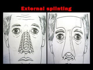 Splintery Fractures Example Facial bone fractures | PPT
