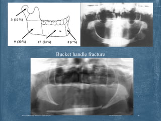 Max Fax Injuries 11. geriatric maxfac trauma(50) Dr. RAHUL TIWARI | PPT