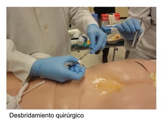 Desbridamiento quirúrgico
 