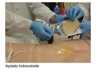 Apósito hidrocoloide
 