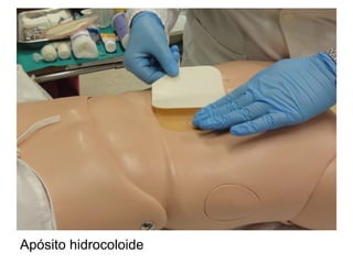 Apósito hidrocoloide
 