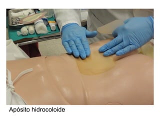 Apósito hidrocoloide
 