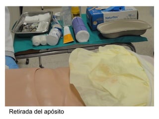 Retirada del apósito
 