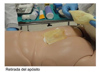 Retirada del apósito
 