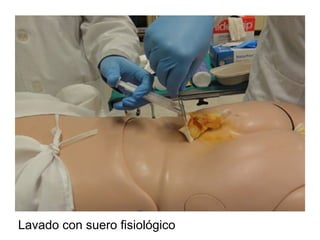 Lavado con suero fisiológico
 