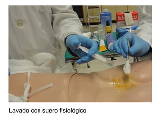 Lavado con suero fisiológico
 