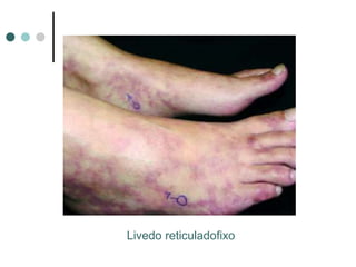 Livedo reticuladofixo
 