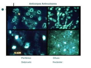 Periférico Difuso
Salpicado Nucleolar
Anticorpos Antinucleares
 