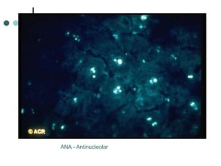 ANA - Antinucleolar
 