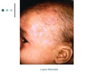 Lupus Neonatal
 