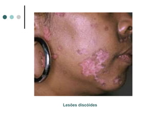 Lesões discóides
 