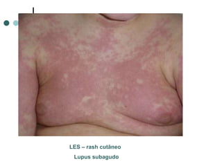 LES – rash cutâneo
Lupus subagudo
 