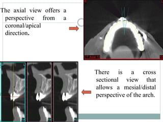 Apical Direction Basic aspects of implants | PPTX
