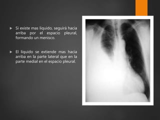  Si existe mas liquido, seguirá hacia
arriba por el espacio pleural,
formando un menisco.
 El liquido se extiende mas hacia
arriba en la parte lateral que en la
parte medial en el espacio pleural.
 
