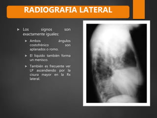  Los signos son
exactamente iguales:
 Ambos ángulos
costofrénico son
aplanados o romo.
 El liquido también forma
un menisco.
 También es frecuente ver
LP ascendiendo por la
cisura mayor en la Rx
lateral.
RADIOGRAFIA LATERAL
 