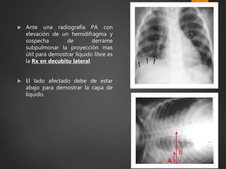  Ante una radiografía PA con
elevación de un hemidifragma y
sospecha de derrame
subpulmonar la proyección mas
útil para demostrar liquido libre es
la Rx en decubito lateral.
 El lado afectado debe de estar
abajo para demostrar la capa de
liquido.
 