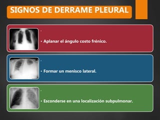 .
• Aplanar el ángulo costo frénico.
.
• Formar un menisco lateral.
.
• Esconderse en una localización subpulmonar.
SIGNOS DE DERRAME PLEURAL
 