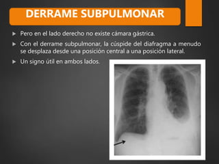  Pero en el lado derecho no existe cámara gástrica.
 Con el derrame subpulmonar, la cúspide del diafragma a menudo
se desplaza desde una posición central a una posición lateral.
 Un signo útil en ambos lados.
DERRAME SUBPULMONAR
 