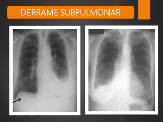 DERRAME SUBPULMONAR
 