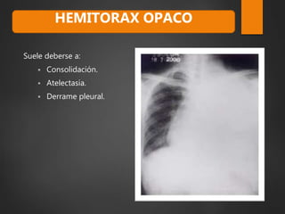 Suele deberse a:
 Consolidación.
 Atelectasia.
 Derrame pleural.
HEMITORAX OPACO
 