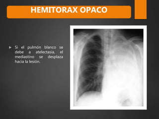  Si el pulmón blanco se
debe a atelectasia, el
mediastino se desplaza
hacia la lesión.
HEMITORAX OPACO
 