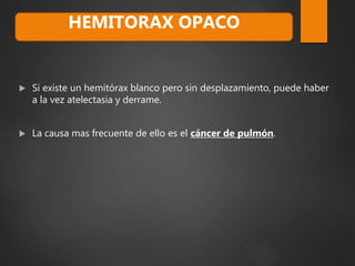  Si existe un hemitórax blanco pero sin desplazamiento, puede haber
a la vez atelectasia y derrame.
 La causa mas frecuente de ello es el cáncer de pulmón.
HEMITORAX OPACO
 